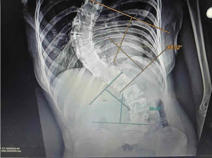 Escoliosis radiografia