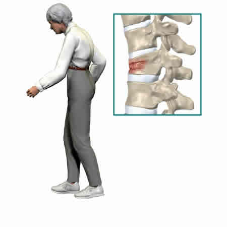 Fracturas por Osteoporosis en columna vertebral