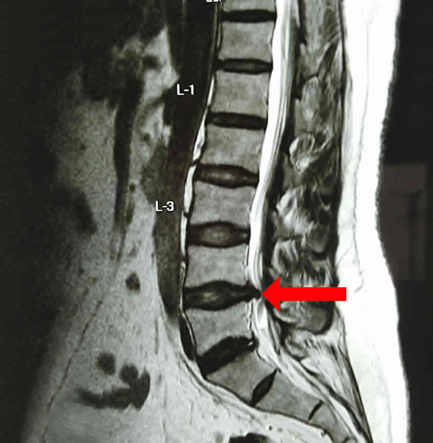 Hernias de Disco