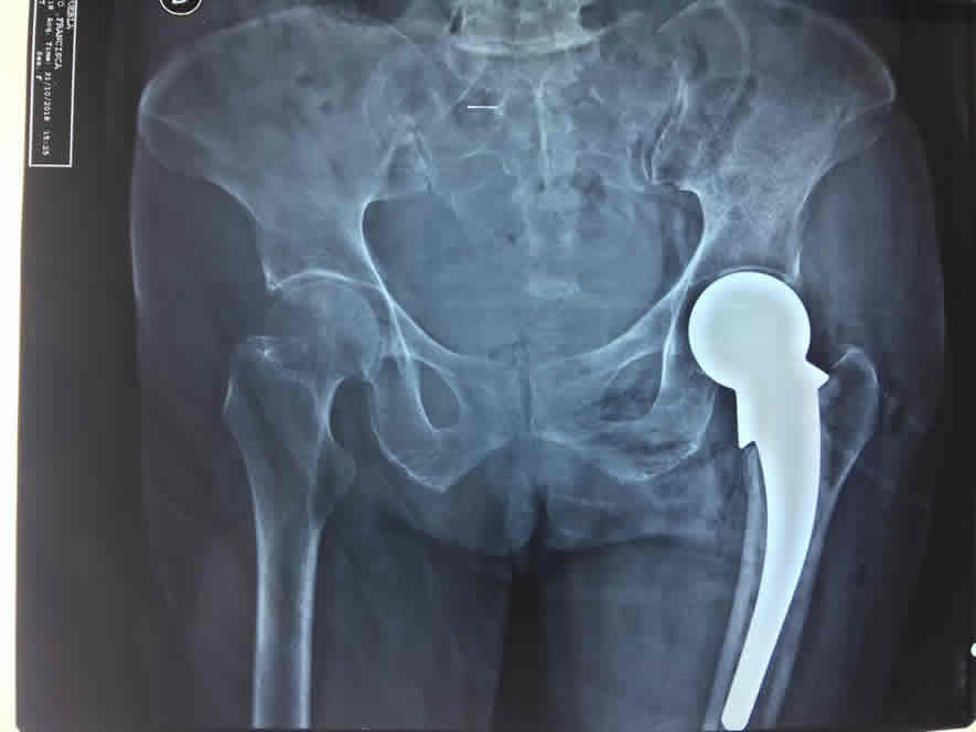 Otros servicios de Ortopedia y Traumatología - Dolor de cadera