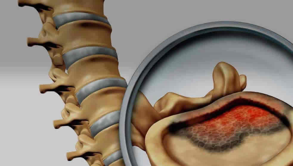 Tumores de Columna Vertebral