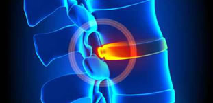 Hernias de Disco